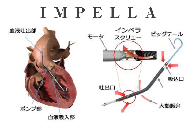 IMPELLA導入